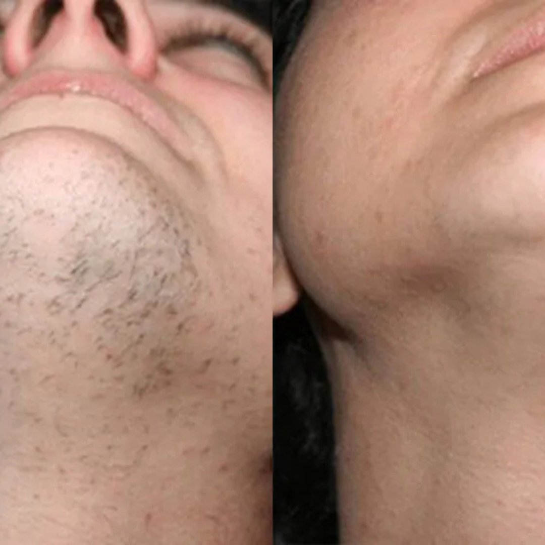 Smooth skin areas for Cavaunory™